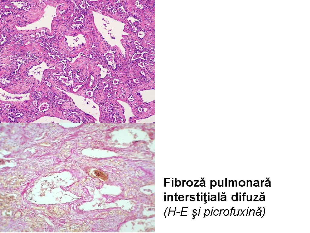 Fibroză pulmonară interstiţială difuză (H-E şi picrofuxină)